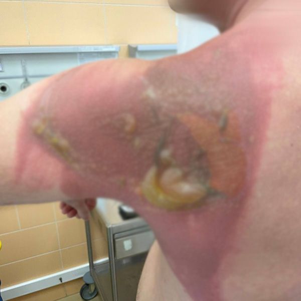 Татарстанец получил химический ожог после стирки постельного белья капсулами из Азии