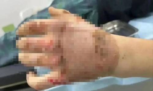 В Альметьевске подросток схватился за оголенный провод и получил серьезные ожоги