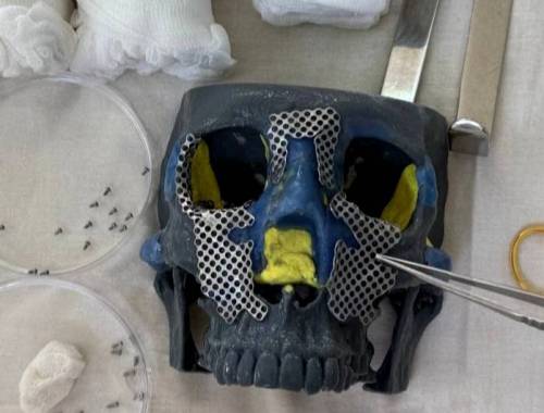 Челнинские врачи восстановили пациентке лицо из 30 осколков