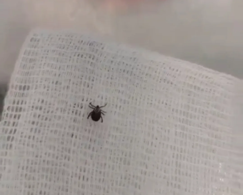 В Татарстане с начала сезона зафиксировано 35 случаев укуса клещей