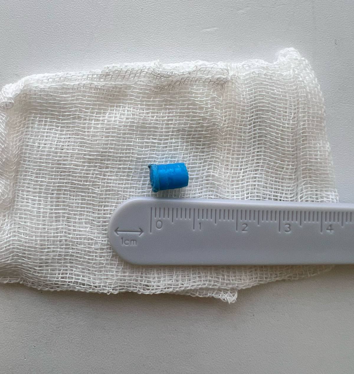 В Челнах спасли 10-летнего ребенка, которому колпачок от ручки перекрыл часть легкого