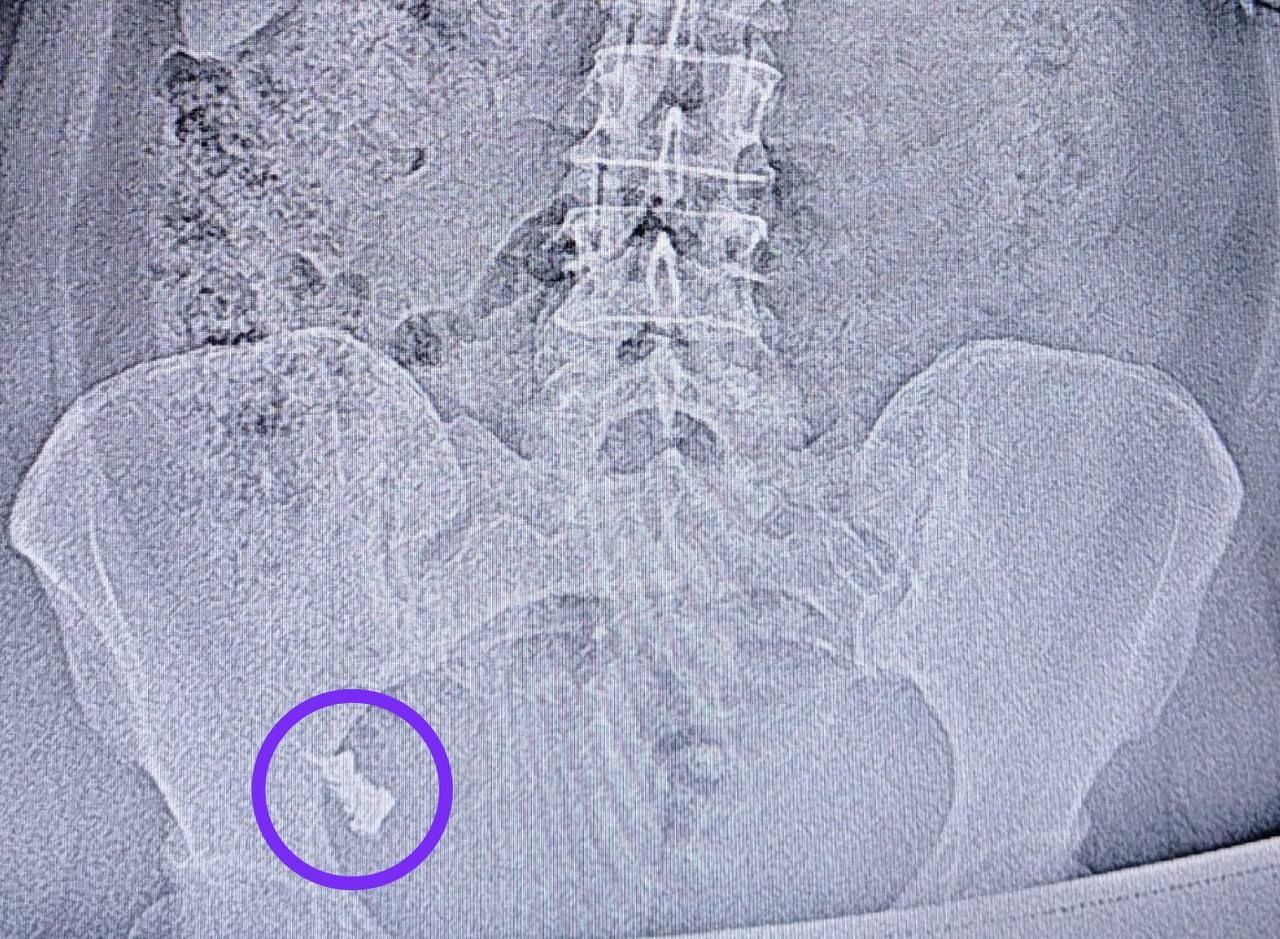 Врачи РКБ извлекли из кишечника жительницы Казани зубной протез