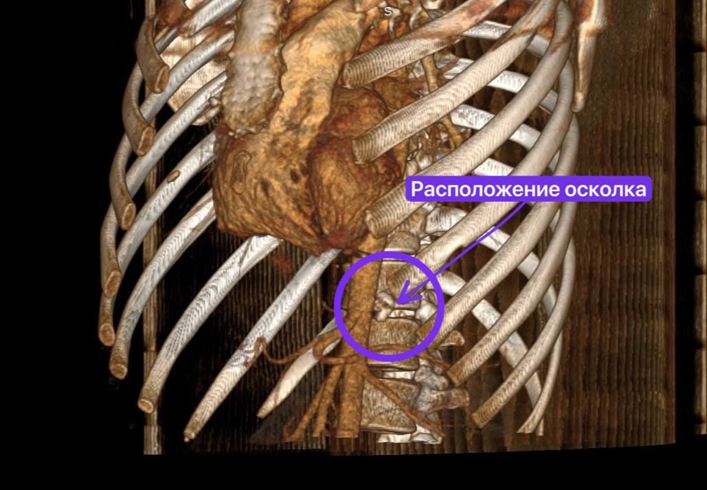 Врачи Татарстана провели бойцу СВО сложную операцию с извлечением осколка