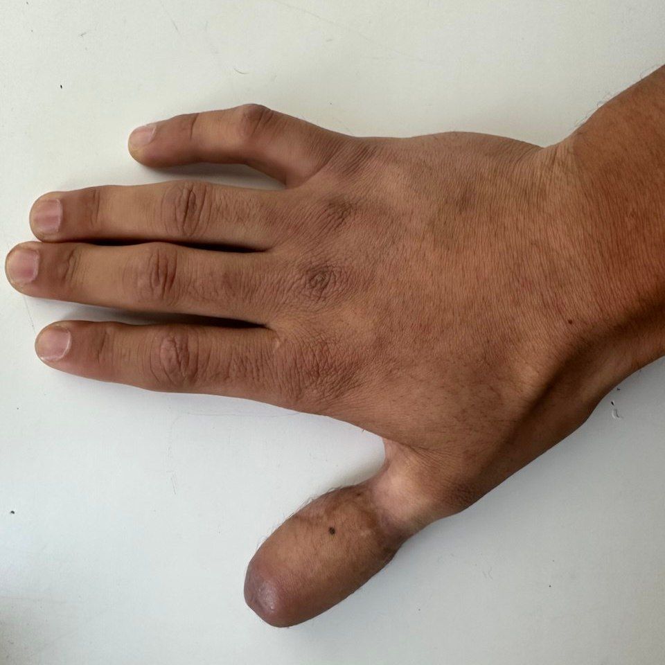 Кость пересадили, руку к животу пришили: как врачи Татарстана выращивают пациентам пальцы