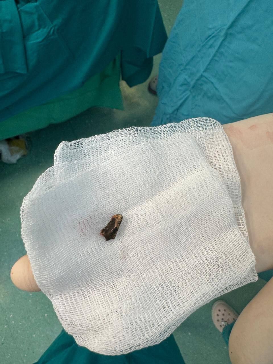 Врачи РКБ спасли бойца СВО с осколком в печени, грозящим его жизни