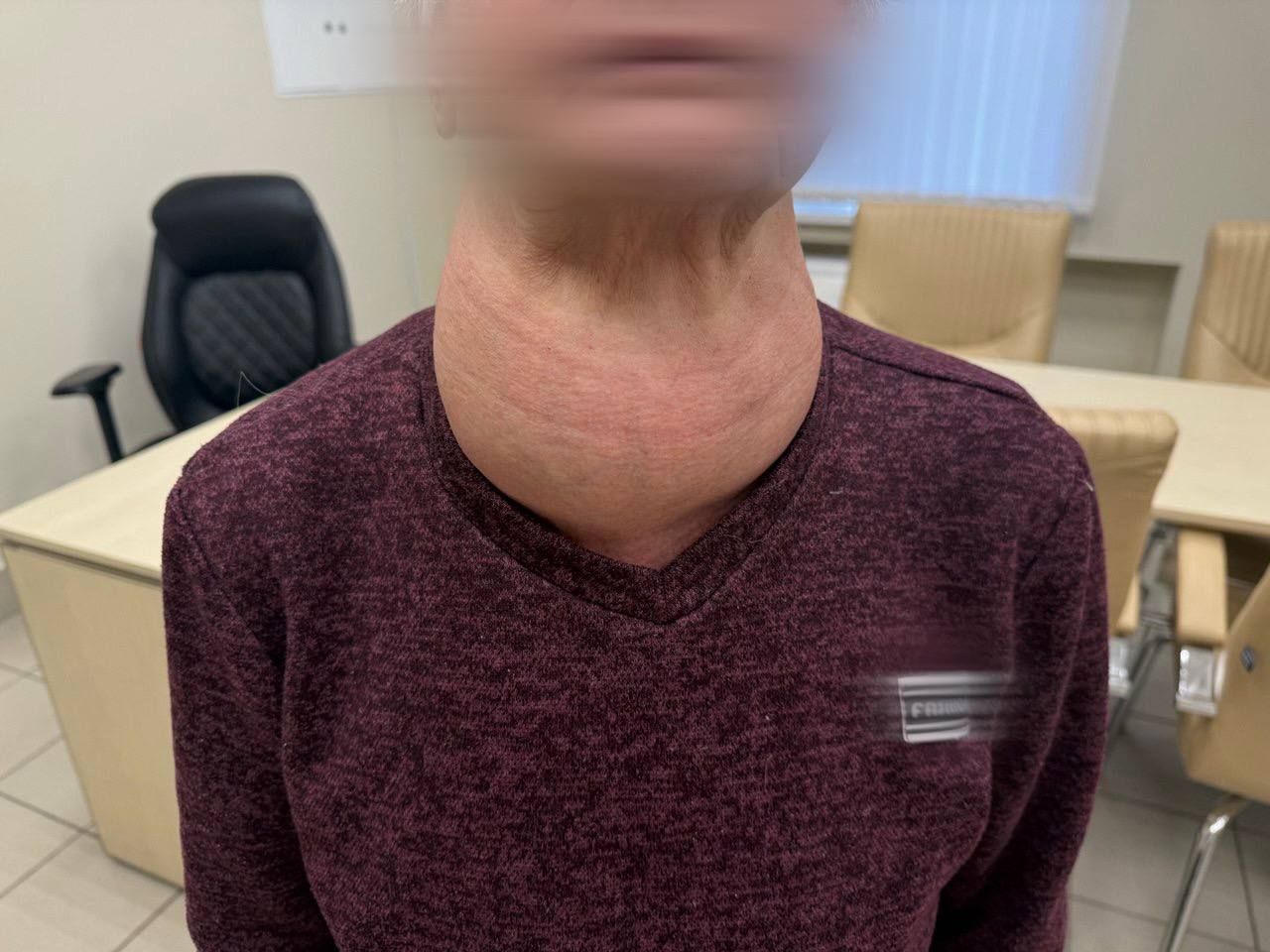 Хирурги РКБ удалили у пожилой жительницы Альметьевска щитовидку размером с голову