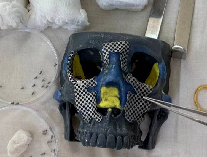 Челнинские врачи восстановили пациентке лицо из 30 осколков