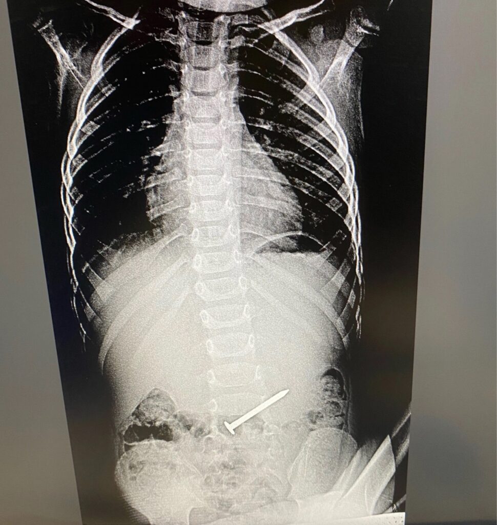 «Как страусы, глотают все»: врач ДРКБ Татарстана – об опасных находках в животах у детей