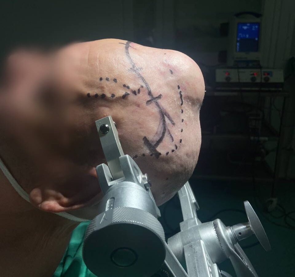 Медики удалили шишку на голове татарстанца – это оказался метастаз от рака почки