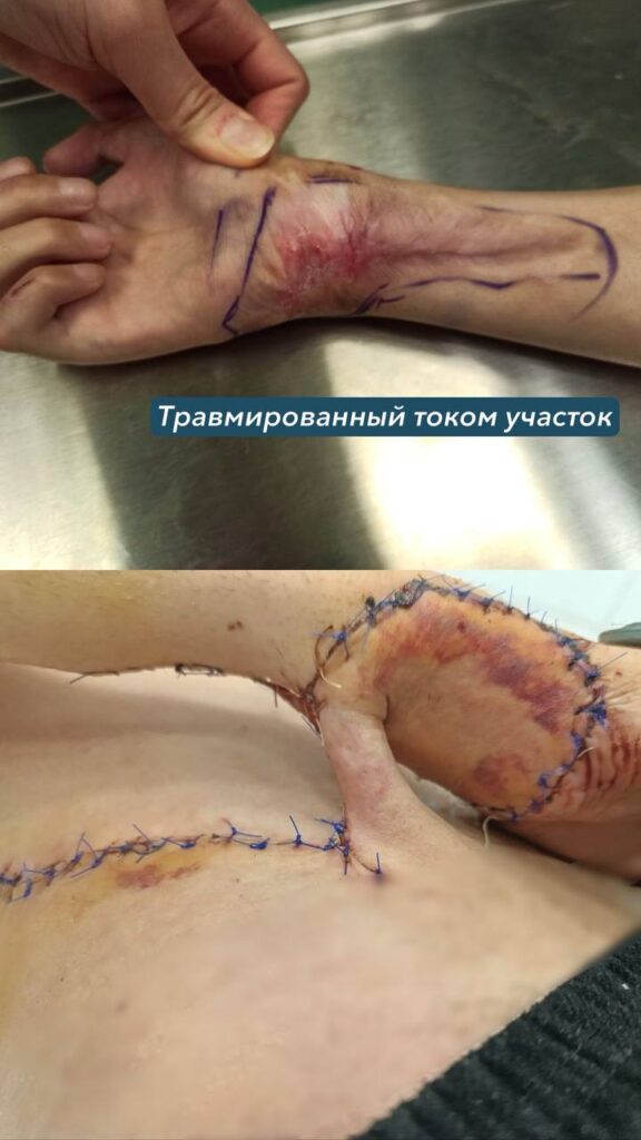 В РКБ рассказали о пациентах, пальцы которых пришивались к животам